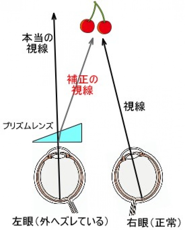 プリズム矯正