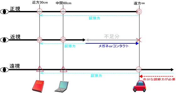 近視