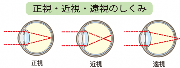 物の見え方　正視　近視　遠視